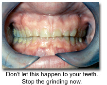 Bruxism - TMJ - Teethgrinding